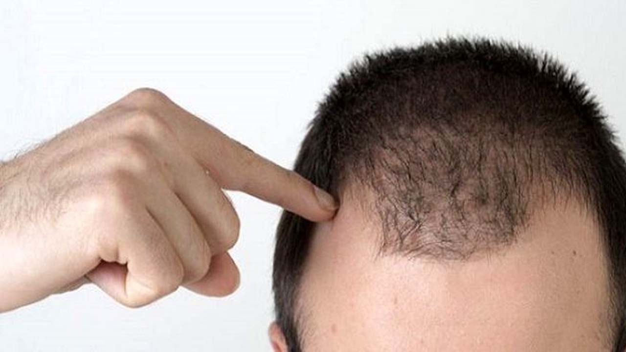 بهترین درمان ریزش مو مردان